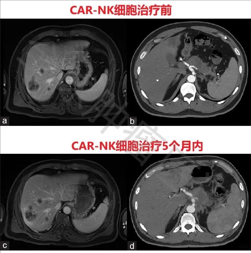 CAR-NK治疗胰腺癌肝转移的效果