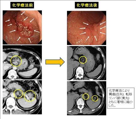 癌研有明医院化疗治疗胃癌的效果