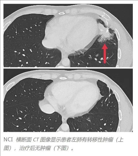 TCR-T疗法治疗结直肠癌的效果