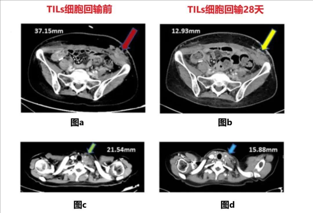 GT101 TIL细胞疗法治疗晚期宫颈癌的效果