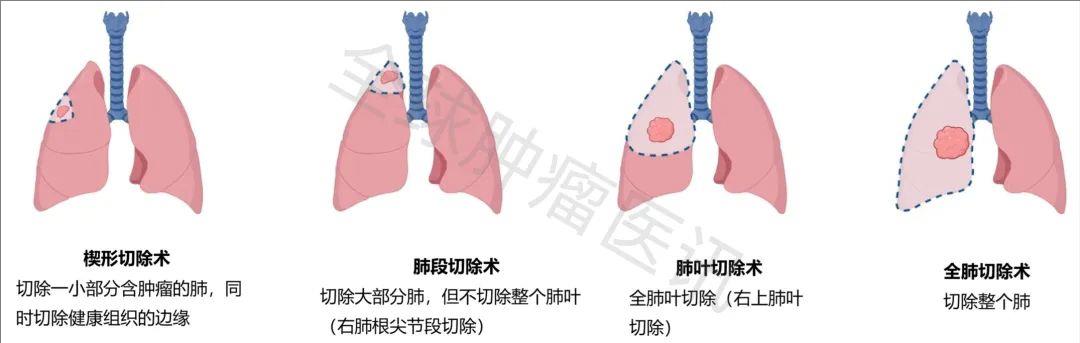 难治的稀有突变型就要用“特效药”！我国自主研发JMT-101再战非小细胞肺癌